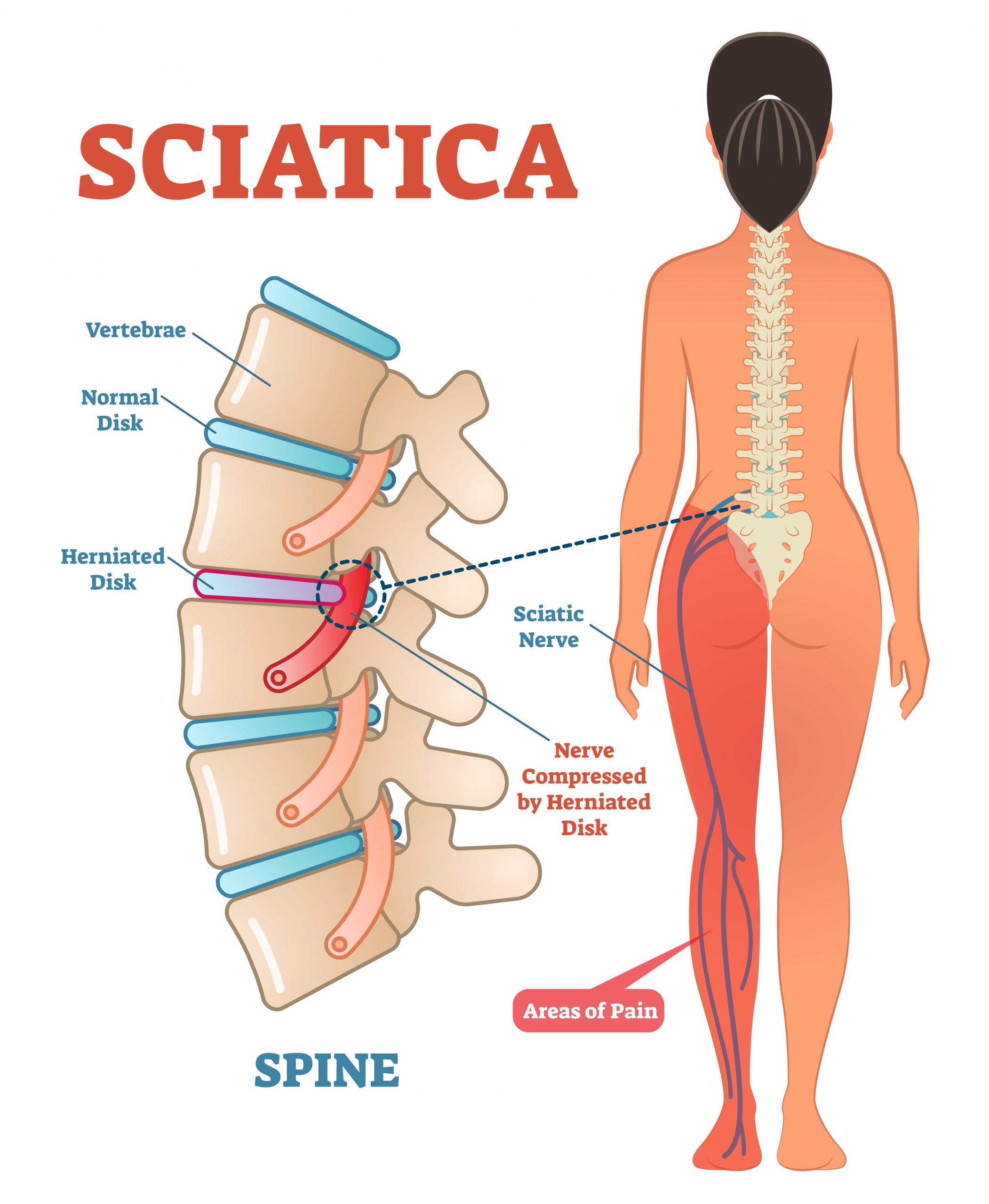 https://www.nonsurgicalspinalcare.com.au/wp-content/uploads/2021/12/Picture-Sciatica-scaled-1.jpg